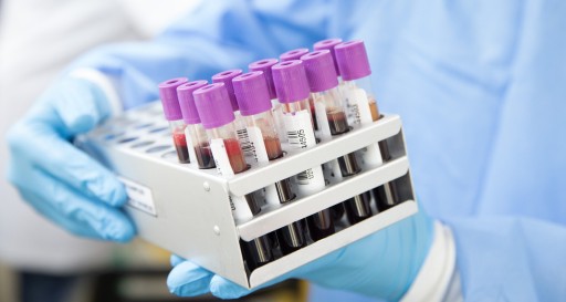 PSA-Wert: die wichtigsten Fragen und Antworten Prostata Hilfe Deutschland: Röhrchen mit Blutproben