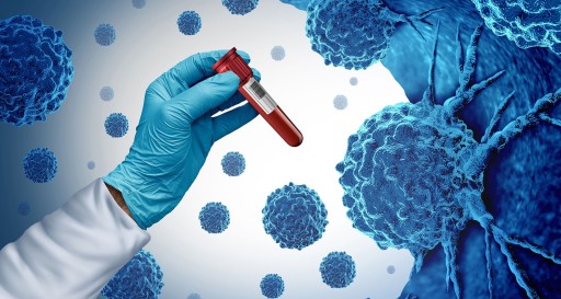 Prostatakrebsfrüherkennung 2.0: wie sie funktionieren soll Grafik Hand mit Blutprobe und Krebzellen im Hintergrund