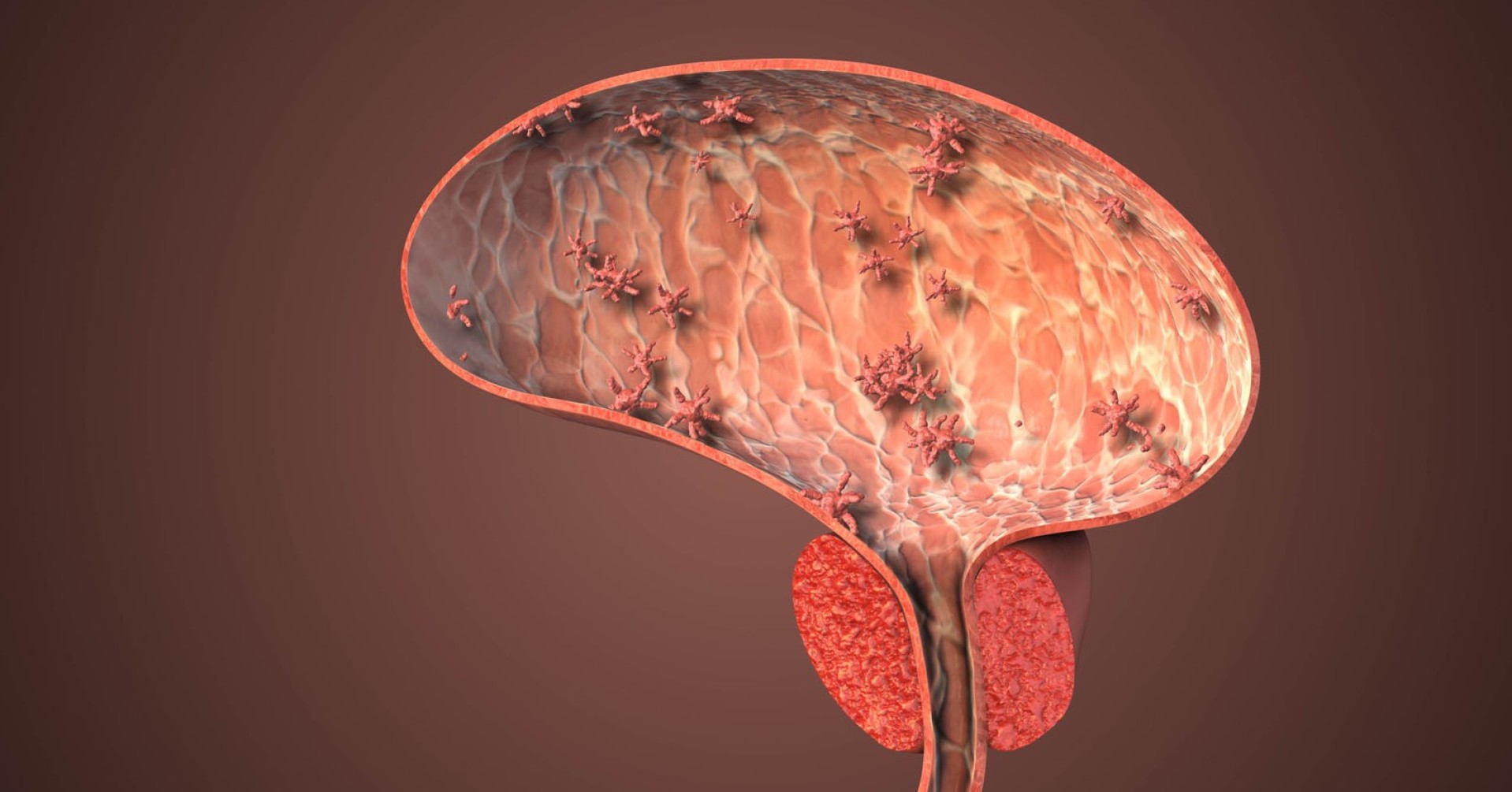 Prostata Hilfe Deutschland: Schematische Darstellung einer Prostata mit Prostatitis, bakterielle Entzündung, Silver Place, iStockphoto