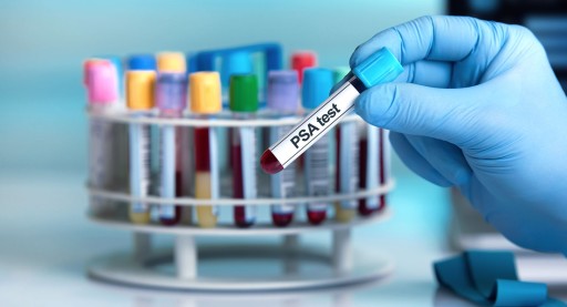 Risikoadaptiertes PSA-Screening kann Prostatakrebs besser aufdecken Prostata Hilfe Deutschland: Labor mit Röhrchen und Aufschrift PSA-Test